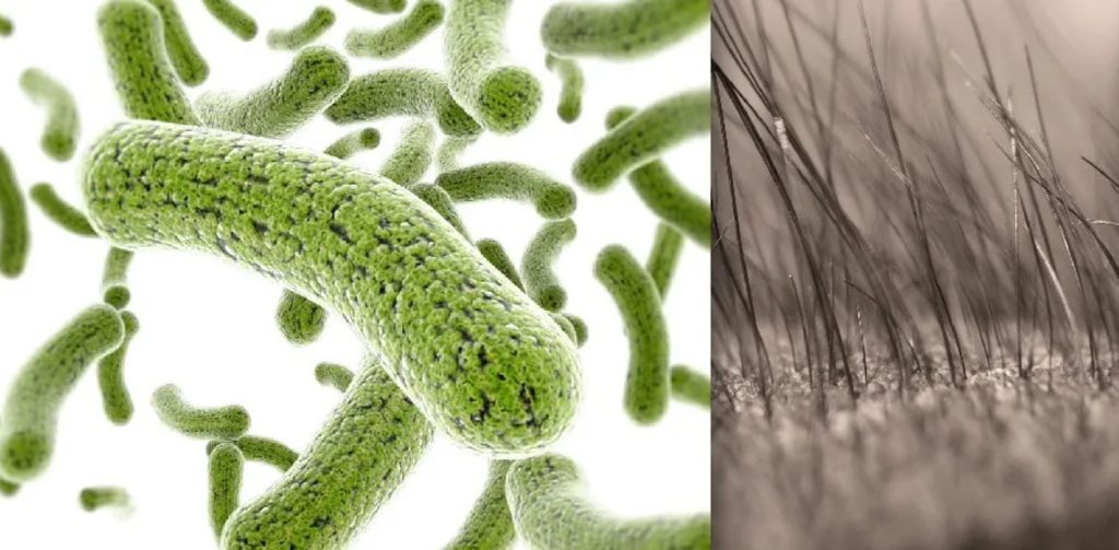 Nấm Malassezia phát triển quá mức trên da đầu